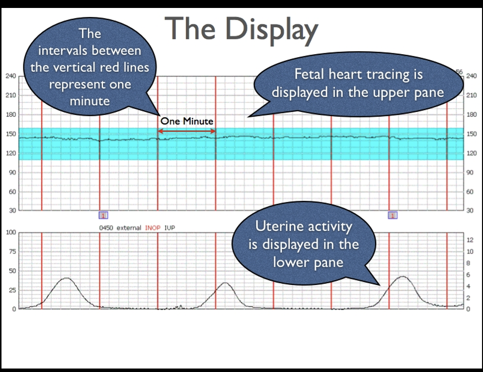 <p>The interpretation of the fetal heart rate tracing should follow a systematic approach with a full qualitative and quantitative description of the following:</p><ul><li><p>Baseline rate</p></li><li><p>Baseline fetal heart rate (FHR) variability</p></li><li><p>Presence of accelerations</p></li><li><p>Periodic or episodic decelerations</p></li><li><p>Changes or trends of FHR patterns over time</p></li><li><p>Frequency and intensity of uterine contractions</p></li></ul><p></p>