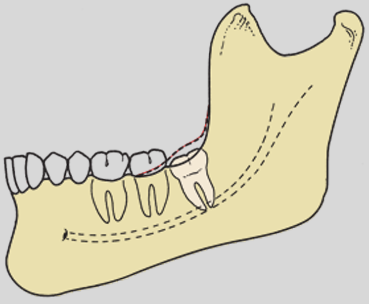 <p>what is the classification of overlying tissue?</p>