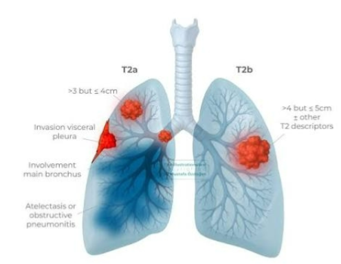 <p>Tumor <strong>>3–5 cm</strong> </p><p>OR a tumor with any of the following:</p><ul><li><p>Visceral pleural invasion</p></li><li><p>Main bronchus involvement (not involving the carina)</p></li><li><p>Atelectasis or obstructive pneumonitis extending to the hilum</p></li></ul><p></p>