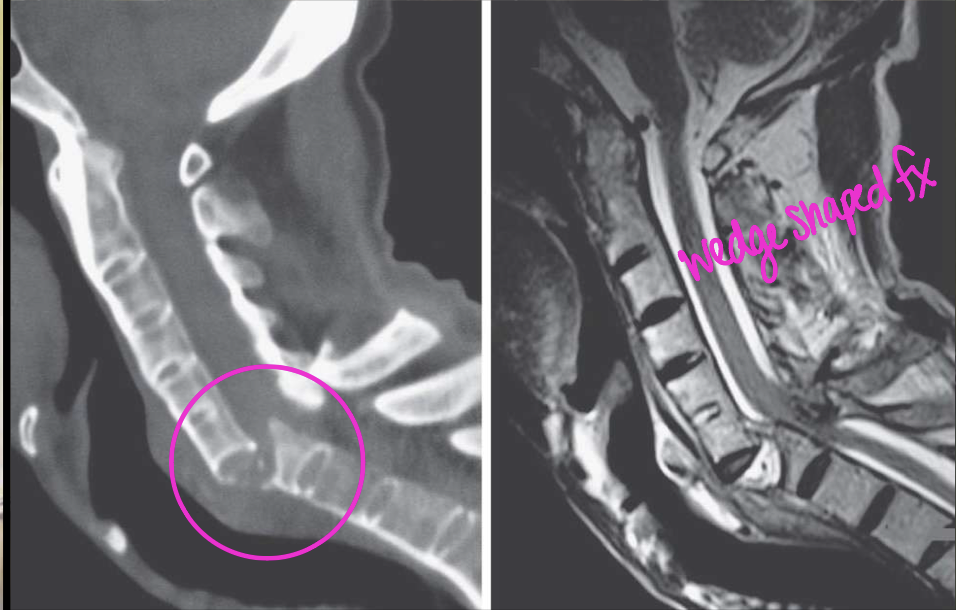 <p>What finding of AS is found in this image</p>