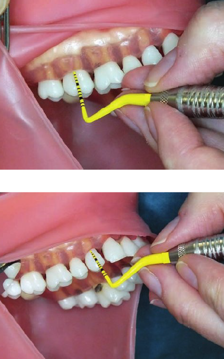 <ul><li><p>1—2 o’ clock position</p></li><li><p>Chin up</p></li></ul><p></p><p><strong>Mirror use (Retraction)</strong></p><ul><li><p>Retract the buccal mucosa w/ the mirror</p></li><li><p><strong>Tip</strong>: Dominant hand is positioned corectly if you can see the underside of middle and ring fingers </p></li></ul><p></p><ol><li><p><strong>Second molar, facial aspect</strong></p></li></ol><ul><li><p>Finger rest on the occlusal surface</p></li></ul><p></p><ol start="2"><li><p><strong>First premolar, facial aspect</strong></p></li></ol><ul><li><p>Finger rest on incisal surface of one of maxillary anterior teeth</p></li></ul><p></p>