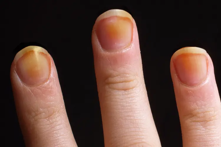 <p>what nail condition is this?</p>