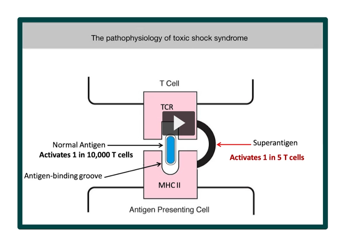 <p><strong>Normal Antigen Presentation</strong> </p><ul><li><p>Antigen sits in <strong>MHC II groove</strong></p></li><li><p>TCR recognizes <strong>specific antigen</strong></p></li></ul><p><span data-name="point_right" data-type="emoji">👉</span> Activates:</p><ul><li><p><strong>~1 in 10,000 T cells</strong> (very controlled)</p></li></ul><div data-type="horizontalRule"><hr></div><p> <span data-name="red_circle" data-type="emoji">🔴</span> <strong>Superantigen Mechanism (TSST-1)</strong> </p><p>Produced by <em>Staphylococcus aureus</em></p><p><span data-name="point_right" data-type="emoji">👉</span> Instead of normal binding:</p><ul><li><p>Superantigen <strong>links MHC II directly to TCR</strong></p></li><li><p><strong>Bypasses the antigen-binding groove</strong></p></li></ul><p><span data-name="point_right" data-type="emoji">👉</span> Result:</p><ul><li><p>Activates:</p><ul><li><p><strong>1 in 5 T cells (~20%)</strong></p></li></ul></li></ul><div data-type="horizontalRule"><hr></div><p> <span data-name="high_voltage" data-type="emoji">⚡</span> <strong>What happens next?</strong> </p><p>Massive activation → <strong>cytokine storm</strong></p><p>Releases:</p><ul><li><p>IL-1 → <strong>fever</strong></p></li><li><p>TNF-α → <strong>hypotension (shock)</strong></p></li><li><p>IL-2 → <strong>T-cell proliferation</strong></p></li></ul><p></p>