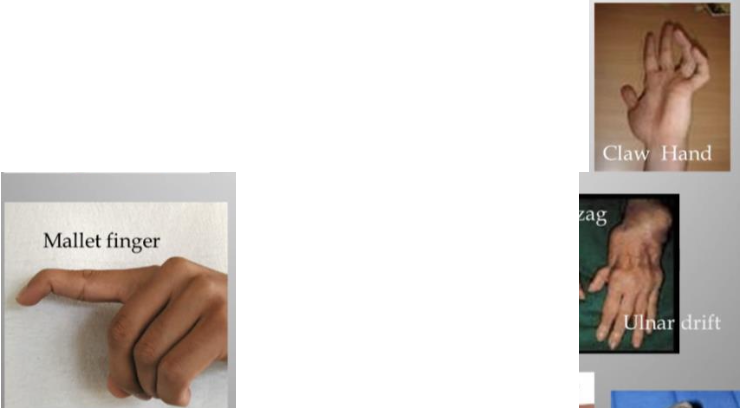 <ul><li><p>Mallet finger</p></li><li><p>Claw hand</p></li><li><p>Ulnar drift</p></li></ul><p></p>