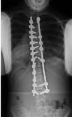<p>surgery</p><p>arrests the curve progression</p>