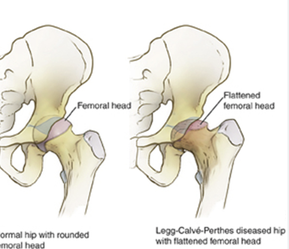 <p>A condition where temporary loss of blood supply to the femoral head causes bone death, leading to hip pain, limp, and limited motion in children</p>