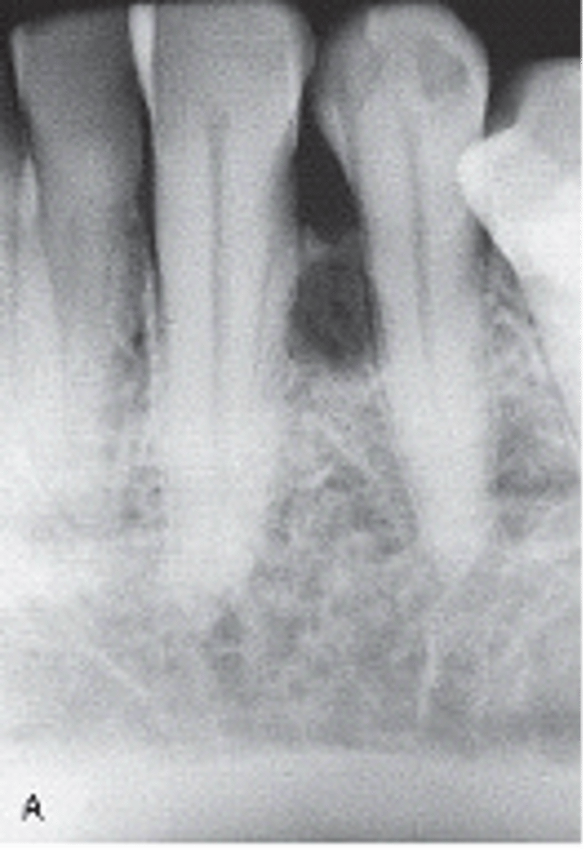<p>-True cyst (epithelial lining)</p><p>-Well circumscribed Unilocular or Multilocular lucency in the lateral periodontal membrane of adults between roots of adjacent, erupted teeth</p><p>-most found in mand premolar region</p><p>-associated tooth is vital</p><p><br><span>This radiolucent lesion located interproximal to the mandibular lateral incisor and canine is most likely which of the following?</span></p>