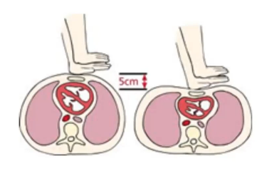 <p>Região hipotenar de uma das mãos 2cm acima do apêndice xifóide, e a outra mão apoiada sobre o dorso da primeira. </p>