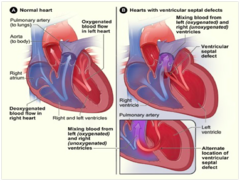 <p>size + pulm vasc resistance pressure = shunt direction</p><p>small defect: L → R shunt (L side less pressure)</p><p>large and complicated: R→ L shunt (Eisenmenger sdr)</p>