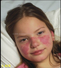 <p>Systemic lupus erythematosus</p><p>Type III Hypersensitivity (antigen-antibody complexes deposit) with glomerulonephritis</p><p>Type II hypersensitivity with autoimmune hemolysis</p>