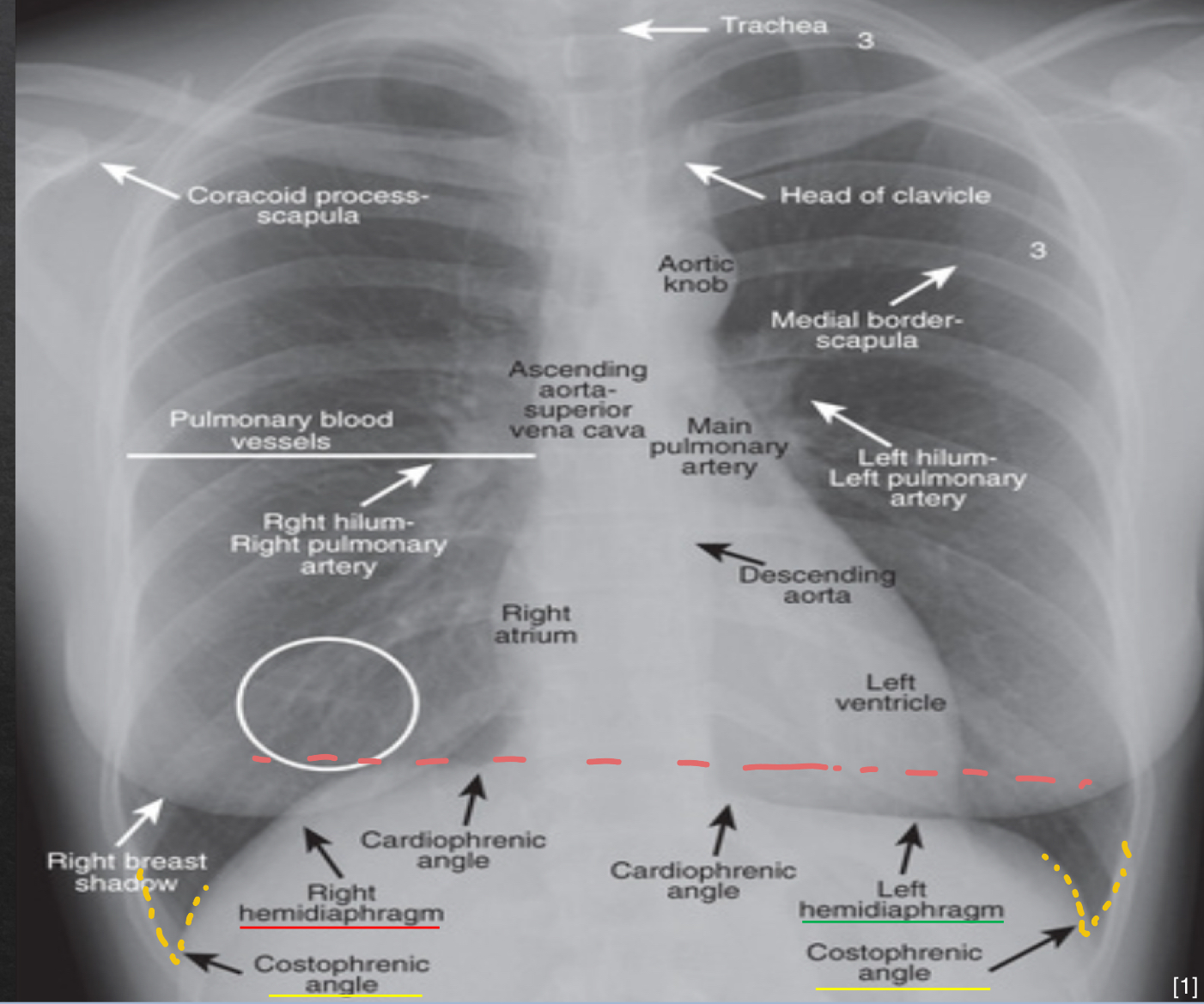 <ul><li><p>right hemi</p><ul><li><p>slightly more elevated</p></li></ul></li><li><p>left hemi</p><ul><li><p>no significant elevation</p></li></ul></li><li><p>costophrenic angles</p><ul><li><p>sharp</p></li></ul></li></ul><p></p>