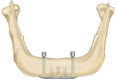 <p>Transosteal/Mandibular staple</p>