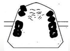 <p>What kennedy classification?</p>