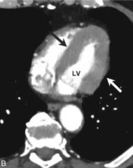 <p>Hypertensive cardiovascular disease with LV hypertrophy and aortic unfolding.</p>