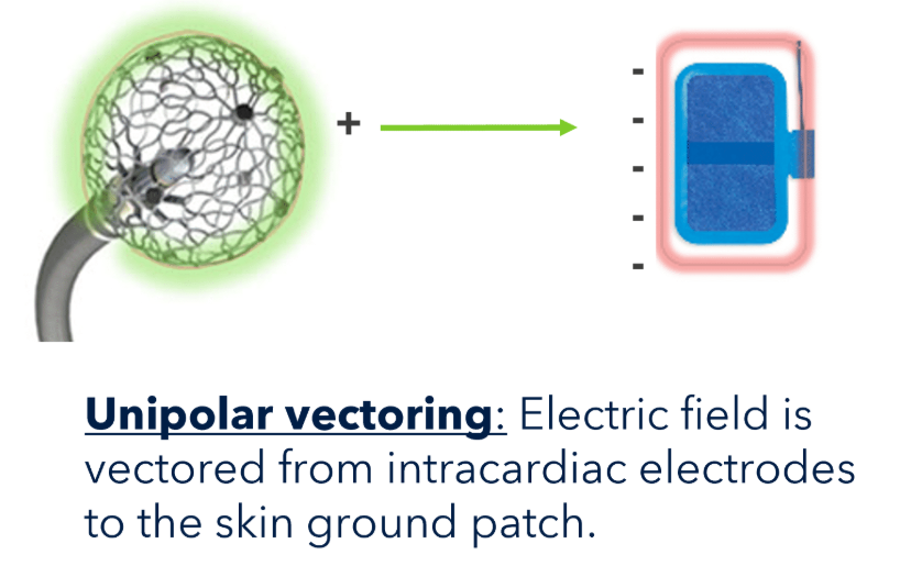 <p><span>In a unipolar vectoring configuration, the electric field is vectored from intracardiac electrodes to the skin ground patch on the patient.</span></p>