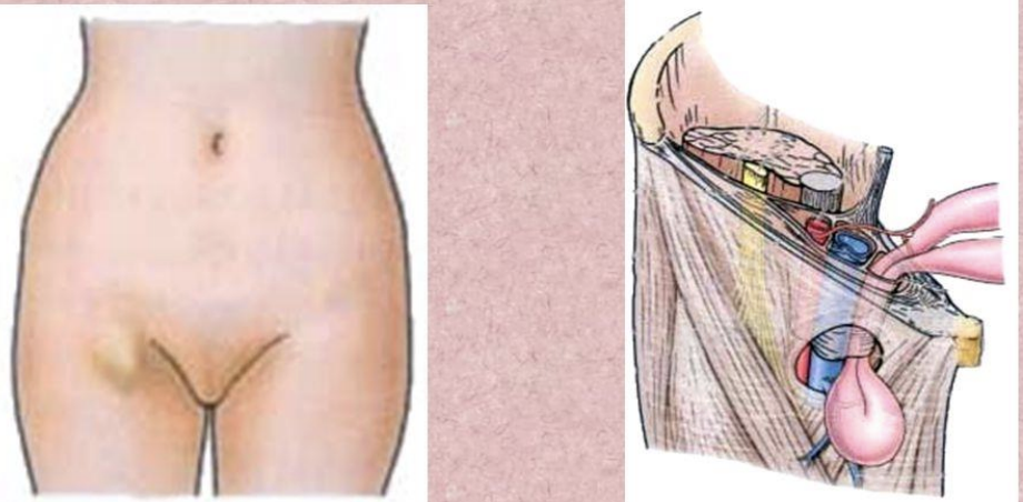 <p>Femoral Hernia</p>