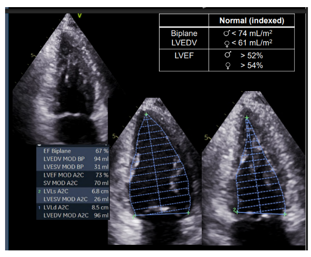 <p>LVEDV (2C)- Biplane</p><p>LVESV (2C)- Biplane</p><p>LVEF- Biplane</p><p></p><p>- trace the LV cavity along the interface of the compacted and noncompacted myocardium of the chamber wall excluding papillary muscles. Make sure LV length is centered</p><p></p><p><strong>timing</strong></p><p>- ventricular end-diastole: one frame after MV closure or when LV is at its largest</p><p>- ventricular end-systole: one frame immediately preceding MV opening or when LV is at its smallest</p>