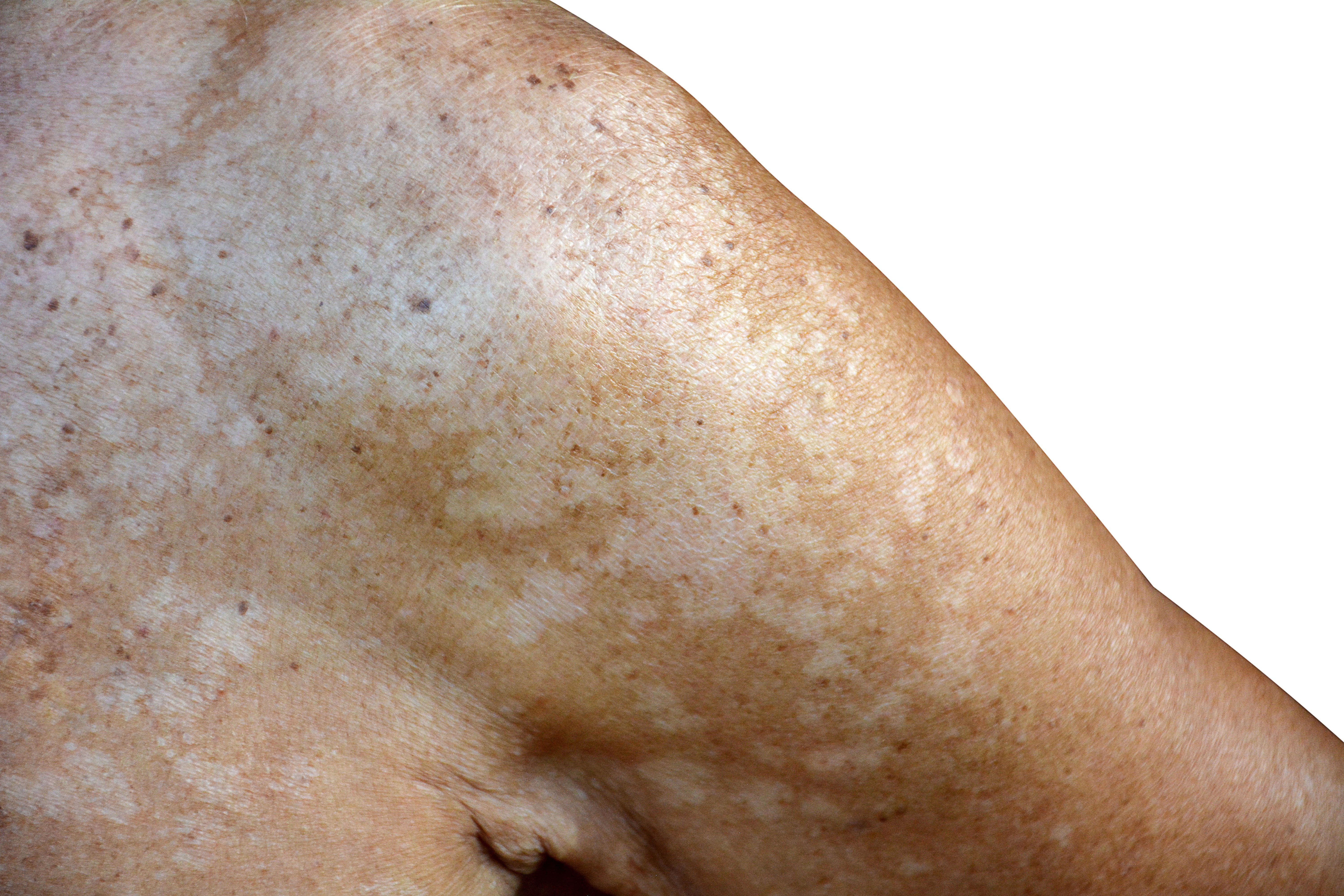 <p>Hypopigmented</p>