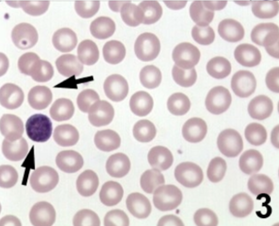 <ul><li><p><span style="background-color: transparent;"><strong>Production Defect</strong>: bone marrow injury, decreased erythropoietin, marrow infiltration.</span></p></li><li><p><span style="background-color: transparent;">Retic: normal to low</span></p></li><li><p><span style="background-color: transparent;"><strong>Differential diagnosis</strong>: aplastic anemia, renal disease, malignant cells</span></p></li></ul><p></p>