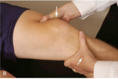 <p>Knee at 0°-30° flexion, anterior tibial translation with femur stabilized; indicates ACL integrity.</p>