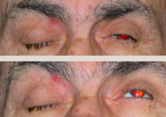 <p>aneurysm!! (likely at circle of willis - PCOM a.)</p><p>Cranial Nerve 3 palsy - Pupil involved ophthalmoplegia</p><p>lid will be down (ptosis)</p>