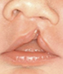 <p>does not involve the nose </p>