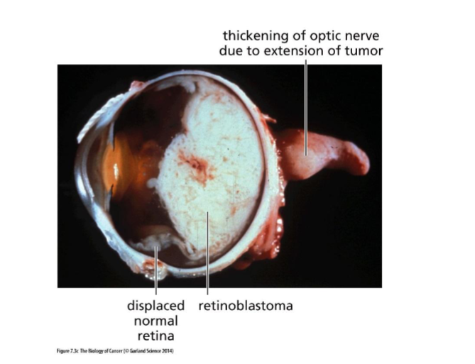 <p>tumor of retina from photoreceptor cells (stem cell precursor of cones)</p>