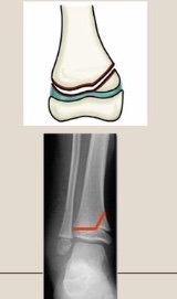<p>Use the Salter-Harris classification system to describe the fracture pattern</p>