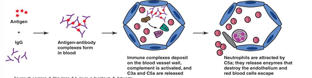 <ul><li><p><span style="color: red;">Immune</span> complex hypersensitivity</p></li><li><p>Occurs when antigen-antibody complexes<span style="color: red;"> induce an inflammatory response</span> in tissues</p></li></ul><ul><li><p>Antigens are <span style="color: red;">freely circulating</span></p></li><li><p>Antigens-Antibodies form large complexes</p></li></ul><p></p><p>Clinical manifestations</p><ul><li><p>Arthus reaction</p></li><li><p>Serum sickness</p></li><li><p>Immune complex deposition disorders (lupus</p></li></ul><p></p>