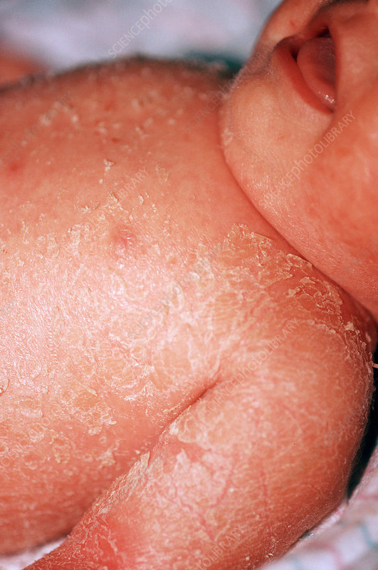 <p>bullous exfoliative dermatitis that occurs primarily in newborns and previously healthy young children</p><p>causes the skin to peel off in sheets</p><p>likely to occur in children under age 2.</p>