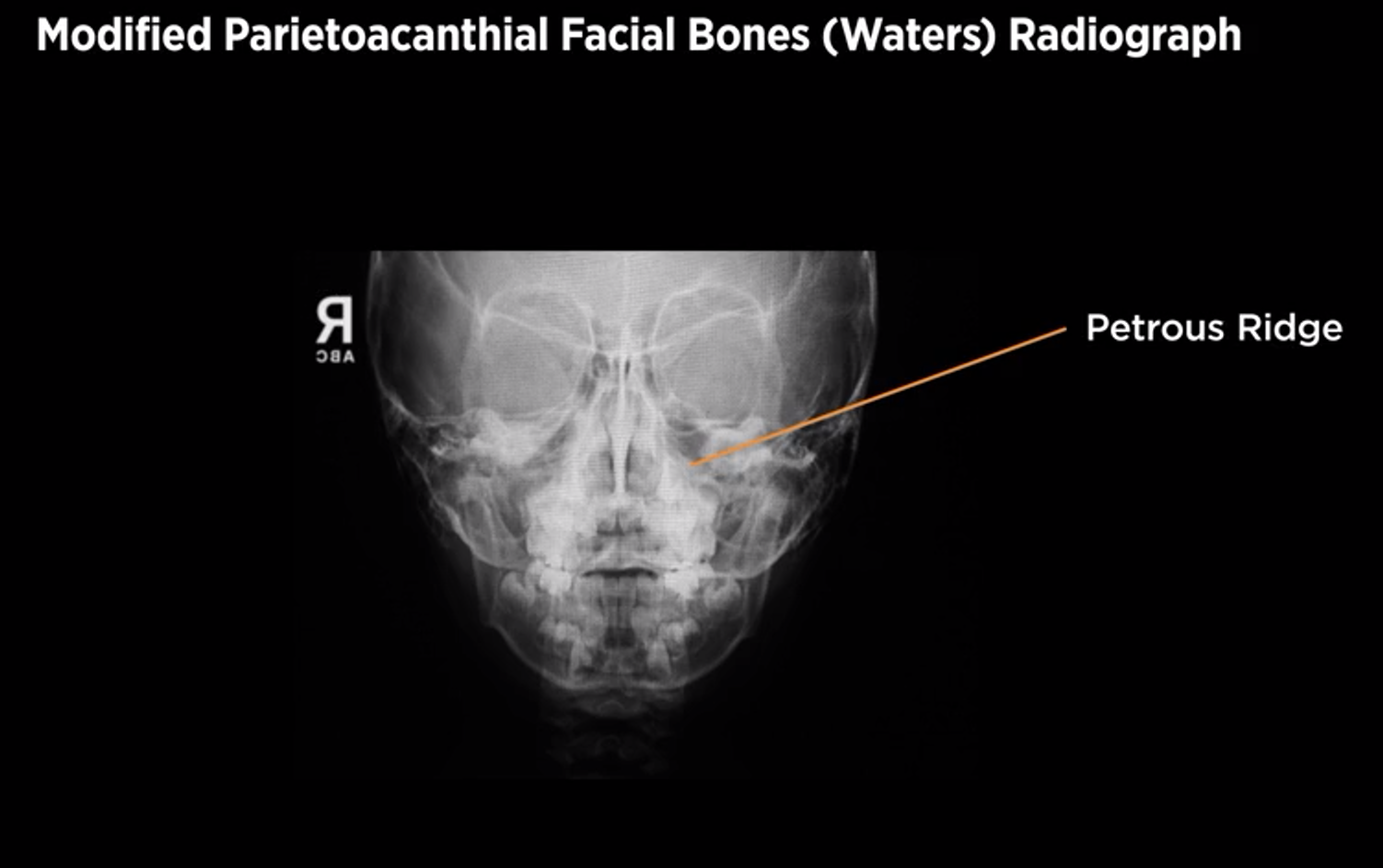 <p>MODIFIED Parietoacanthial facial bones (Modified waters)</p>