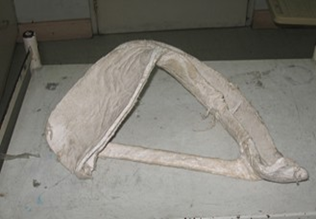 <p><span>fracture of the neck of the humerus / recurrent shoulder dislocation</span></p>