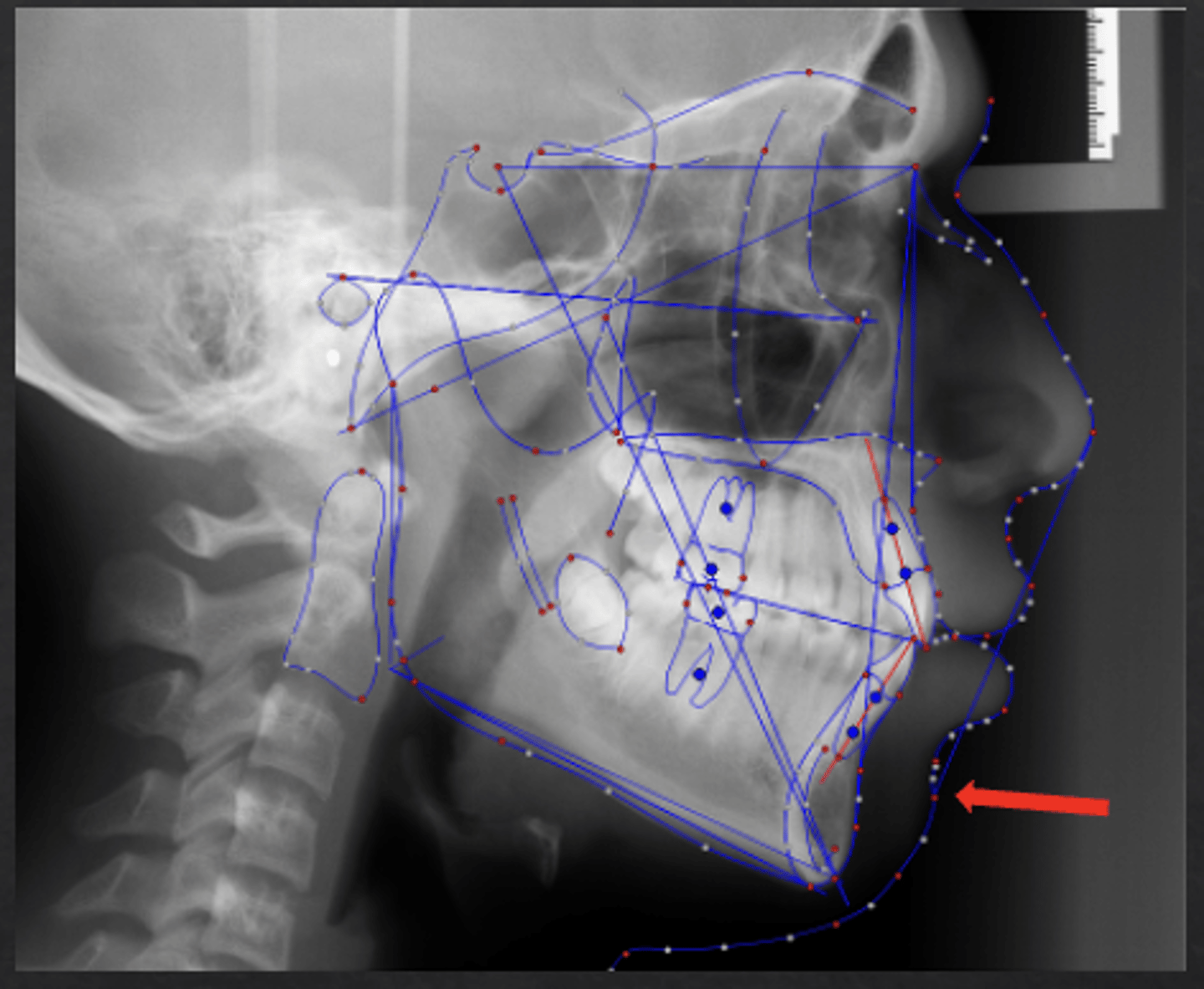 <p>which anatomical landmark:</p><p>- Most anterior point on the curve of the soft tissue chin</p>