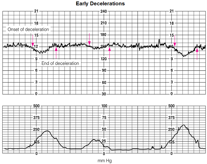 <p><span style="color: rgb(31, 169, 126);"><strong>gradual drop</strong></span> in FHR during contractions (GOOD)</p><ul><li><p><span style="color: rgb(41, 186, 169);"><strong>mirrors contractions</strong></span><span style="color: rgb(10, 14, 13);">—goes down after peak and recovers before contractions end</span></p></li></ul><ul><li><p><span style="color: rgb(10, 14, 13);">cause</span><span style="color: rgb(41, 186, 169);">: <strong>head compression</strong></span> (NORMAL)</p></li></ul><p></p>