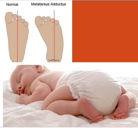 <p>Metatarsus adductus </p>