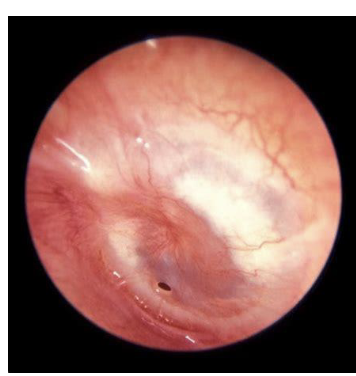 <p><span style="font-size: calc(var(--scale-factor)*12.27px);">This is an example of a perforated eardrum through the otoscope</span></p><ul><li><p><span style="font-size: calc(var(--scale-factor)*12.27px);">Uncomplicated perforations normally heal themselves.</span></p></li><li><p><span style="font-size: calc(var(--scale-factor)*12.29px);">ENT specialists in hospital can apply patch treatments to assist</span><span><br></span><span style="font-size: calc(var(--scale-factor)*12.27px);">their healing.</span></p></li><li><p><span style="font-size: calc(var(--scale-factor)*12.27px);">Ear drops should not be applied to these cases.</span></p></li><li><p><span style="font-size: calc(var(--scale-factor)*12.27px);">Currently no pharmacy treatments are available and these cases</span><span><br></span><span style="font-size: calc(var(--scale-factor)*12.27px);">should be referred.</span></p></li></ul><p><br></p>