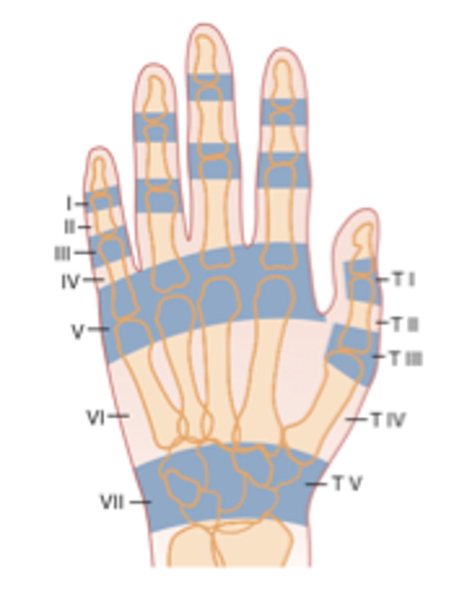 <p>8 Different Zones:</p><p>-Zone 1: DIP joint</p><p>-Zone 2: Middle Phalanx</p><p>-Zone 3: PIP joint</p><p>-Zone 4: Proximal Phalanx</p><p>-Zone 5: MP joint</p><p>-Zone 6: Metacarpal</p><p>-Zone 7: Dorsal Retinaculum</p><p>-Zone 8: Distal Forearm</p><p>5 Thumb Zones:</p><p>-Zone 1: IP joint</p><p>-Zone 2: Proximal Phalanx</p><p>-Zone 3: MP joint</p><p>-Zone 4: Metacarpal</p><p>-Zone 5: CMC joint/Radial Styloid</p>