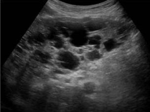 <p>cysts are only in liver, Caused by inherited developmental defect in formation of bile ducts</p>