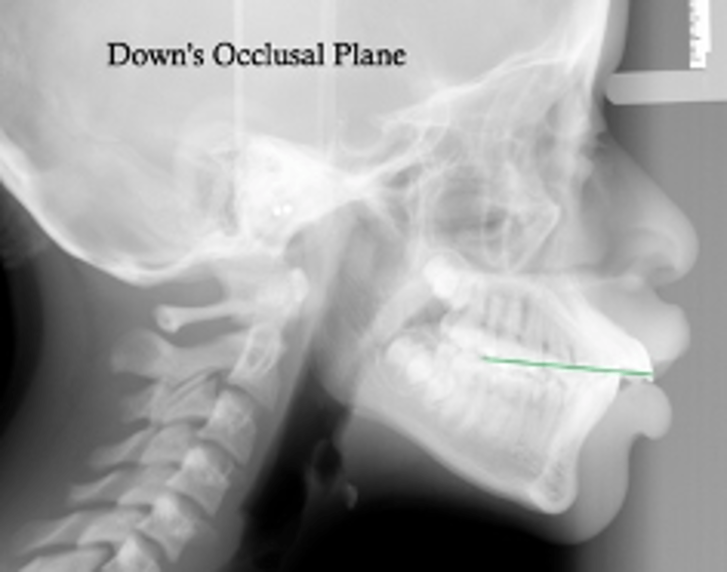 <p>which reference plane:</p><p>- Point 1: Molar occlusal contact</p><p>- Point 2: Bisection of the overbite</p>