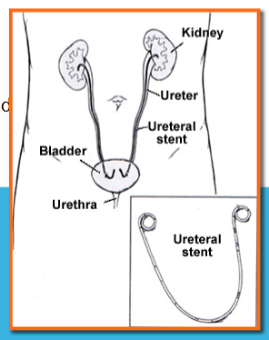 <p>Calcium (most common)</p><p>• High doses of Vit D</p><p>• Intestinal bypass surgery (d/t metabolic changes)</p><p>• Metabolic disorders- renal tubular acidosis</p><p><strong>Struvite</strong>- calcium, magnesium, ammonium and phosphate</p><p>• Usually caused by a UTI</p><p>Uric acid</p><p>• Chronic diarrhea or malabsorption</p><p>• High protein diet</p><p>• Diabetes</p><p>• Metabolic syndrome</p><p>Cystine (amino acid)</p><p>• Hereditary disorder - cystinuria</p>