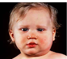 <ul><li><p>mumps</p></li></ul><p></p>