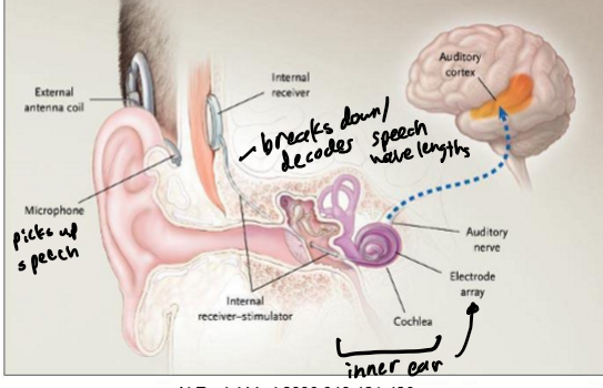 <p>lower f - inner ear and higher f - outer ear; cons - electrodes can have fibrosis which can decrease the stimulation and regeneration of nerve cells and the sounds sound artifical</p>