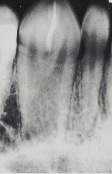 <p>one tooth trying to split </p>