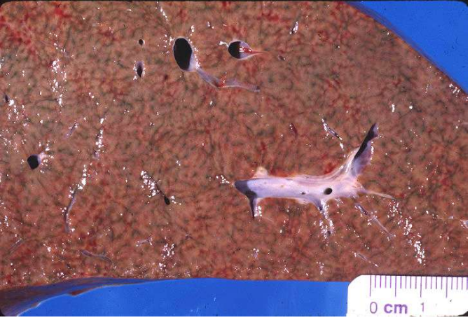 <p>Intracellular accumulations: Hemosiderin/Hemosiderosis</p>