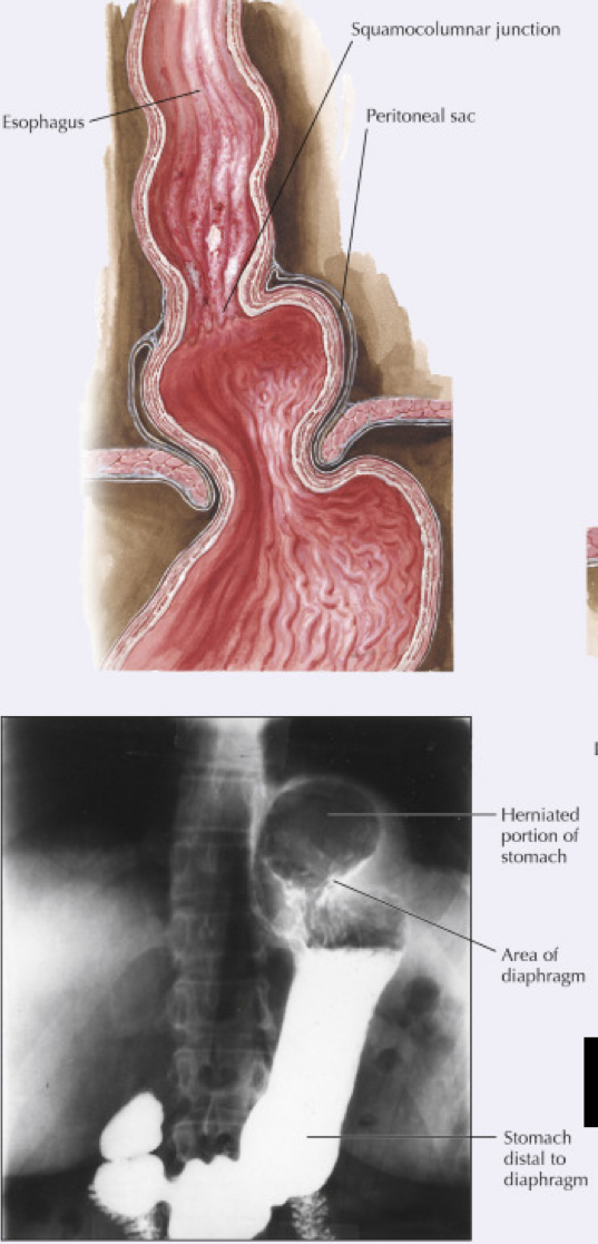 <p>This type of hiatal hernia accounts for >95% of cases and appears like a bell on imaging.</p>