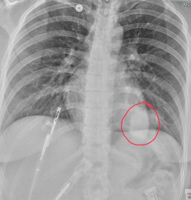 <p>25-year-old female has worsening of a recurrent cough. She has a history of overseas travel and exposure to unsanitary conditions and animal droppings.</p>