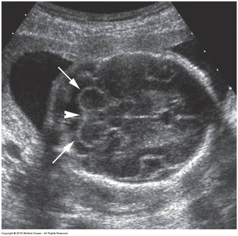 <p>the arrowhead is pointing to what?</p><ul><li><p>cerebellar vermis</p></li><li><p>cerebellar hemispheres</p></li><li><p>cisterna magna</p></li><li><p>csp</p></li></ul><p></p>
