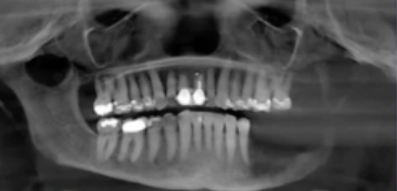 <p>all the following are in the DDx EXCEPT: </p><p>SCC</p><p>metastatic disease</p><p>langerhan cell histocytosis </p><p>ameloblastoma </p>