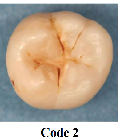 <p>Distinct visual changes in enamel translucency visible when tooth is wet</p>