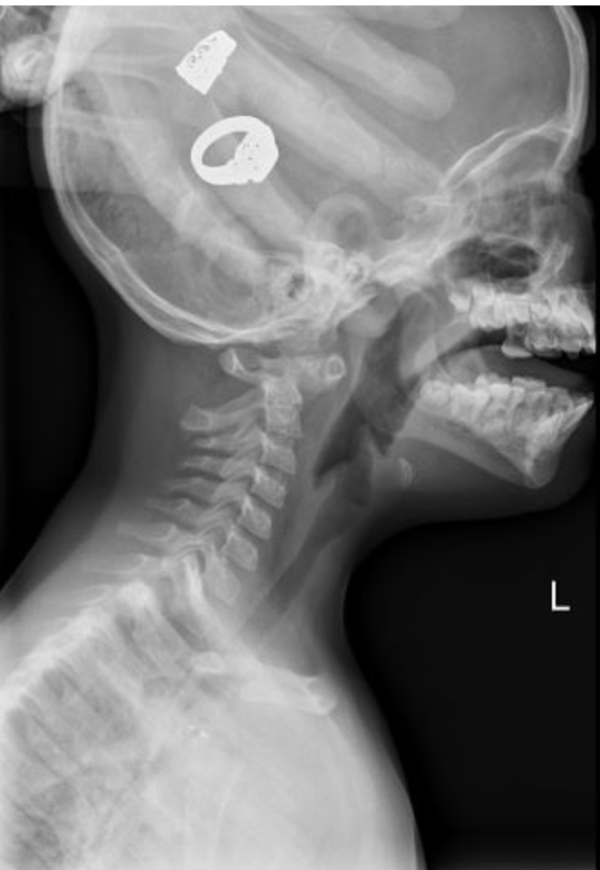 <p>20% are born without the transverse ligament; increased ADI indicates atlantoaxial instability; must perform stress films before treatment is commenced </p>